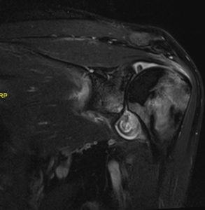 RA MRI shoulder.Seq7.Ser8.Img12